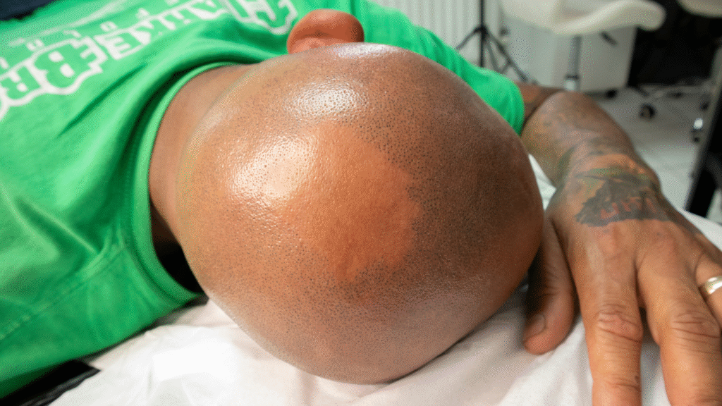 SMP Healing Process